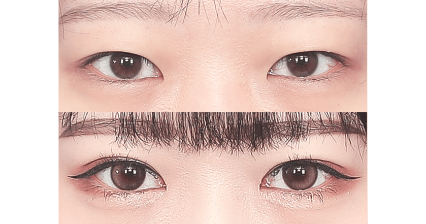 시술 사례 3
