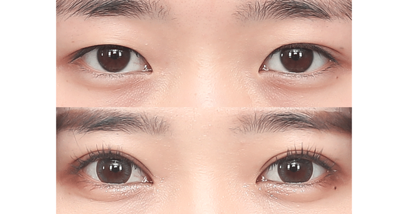 시술 사례 2